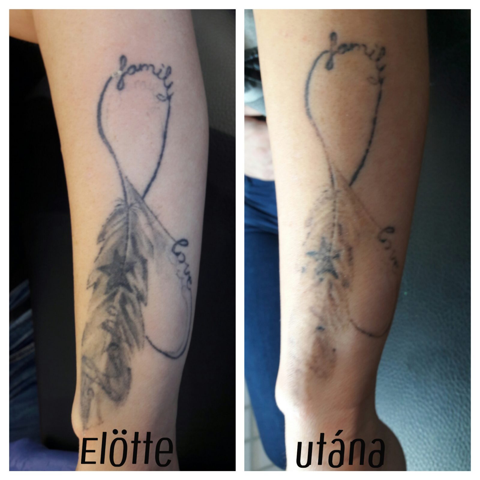 svájci anti aging tetoválás eltávolítás