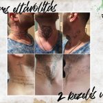 nyak tetoválás eltávolítás, neck tattoo removal