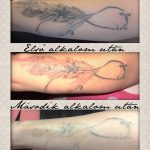 alkar tetoválás eltávolítás három, forearm tattoo removal three